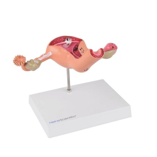 Uterus-model with diseases