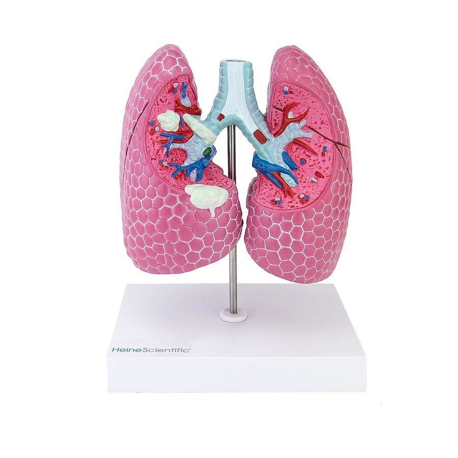 Lung disease model - Winterthur Medical Plc. medical devices