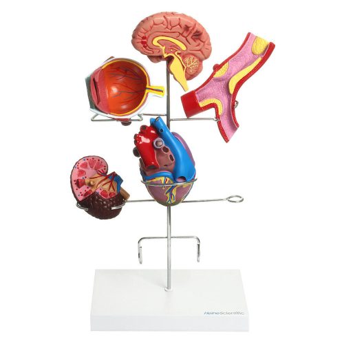 Hypertension model