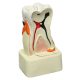 Tooth model with diseases