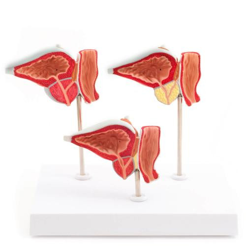 3 - part prostate disease model