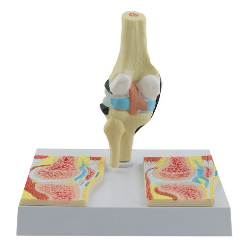 Rheumatic knee joint model