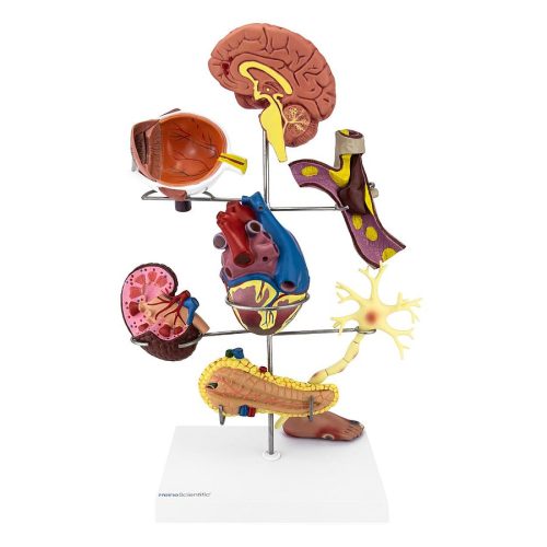 Diabetes model with secondary diseases