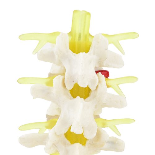 Herniated disc model