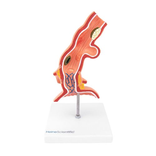 Oesophagus-modell mit erkrankungen